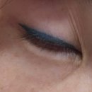 그날성형외과의원 | 컴포트 성형외과 솔직 리뷰 아이라인 문신제거 후기