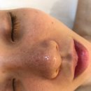 티에스메디 | 수원피부관리 레브메디스파 여드름관리 블랙헤드까지 해결했어요