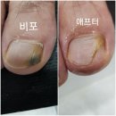 루덴네일