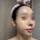 잠실피부과 추천 리쥬란 통증 없이 꿀쥬란 후기 2주 효과