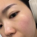 합정약국 | [편평사마귀 성지_합정] 편평사마귀 레이저제거 일주일 후기, 어븀야그 레이저, 내돈내산