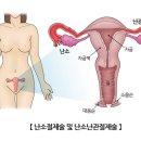 ﻿난소절제술 및 난소난관절제술 이미지