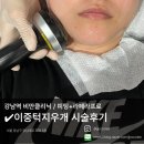 지우개의원 | 강남역 비만클리닉 다이어트 전문의원 : 이중턱지우개 피팅+라페라프로 이중턱+리프팅 시술 후기.