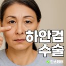대인약국 | 하안검수술 후기 회복기간 방법 운동 가격 ✅(2025년)