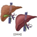 간이식 후 상태 (Liver Transplantation status) 이미지