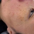 흑자헬스장 | 흑자 제거비용 강서구잡티제거 주근깨 색소 후기