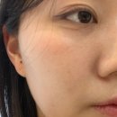 생기한의원스킨케어 | 강남 히알루론산 스킨부스터 듀얼젠 후기 효과 통증