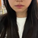 진주사 | 압구정로데오역 지방분해주사 2회차 솔직 후기! 갸름해진 내 얼굴형 자랑하기