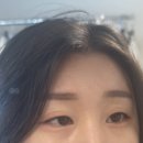 청담디어의원 | [서울/청담] 볼륨꺼진 이마에 심폐소생술..! 이마필러 후기 청담디어의원 솔직후기