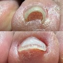 울산연세병원 | 울산문제성발관리 추천, 부모님 내성발톱 관리 다녀온 후기