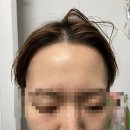 피부관리샵 추천] ‘클린페이스’ 재방문해서 여드름 압출 받은 후기(성인여드름/좁쌀여드름/수부지 피부)