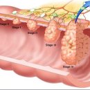 직장 신경내분비종양이란 이미지