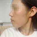 400 | 대전 &#34;올타이트리프팅 400샷&#34; 리얼 후기