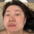 경기바이오 | 경기광주 피부관리 엘덤에스테틱 바이오리필 솔직후기와 재방문 이유