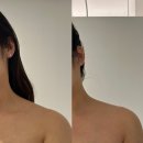 대전 승모근 관리 잘하는 이프로움 예비신부의 등관리 후기