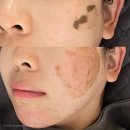 미쓰버블 | 범계피부관리 어텀에스테틱 색소침착 재생 필링 찐 후기