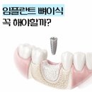수유역 임플란트, 뼈이식이 꼭 필요한 경우는 따로 있습니다 / 수유역 에스다인치과