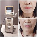 2022_2_강남역-1 | N번째 방문하는 강남역 피부과 울쎄라 300샷 후기 총정리