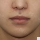 시원한마디의원 | 입꼬리수술 후기만 보고 결정하지마세요