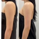 주식회사 케어원 대구지사 | 대구 팔뚝살 티리온x (온다리프팅 효과), 흔들리는 팔뚝살과 겨드랑이 살 단 1회 직후 변화!