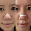 미주약국 | 강남역 복코 재재재수술 1주일차 후기 (자가늑,통증,피고임)고딩때 코수술 하지마세요 젭알plz