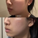 온고을로 | 전주 서신동 피부과 동안리프팅 [필스토리의원] 고현정리프팅 텐트리플 200샷 후기