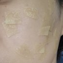 성북제일의원 | <갤러리아피부과 성북>내돈내산 Co2레이저 2주 후 최종후기with날짜별 초상세후기,듀오덤관리😆