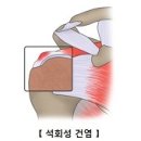 석회성 건염 (Calcific tendinitis) 이미지