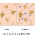 치매 : 알츠하이머질환