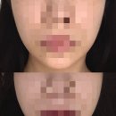 콤마에스테틱에서 얼굴라인 정리하고 왔어요 서면윤곽관리 솔직후기