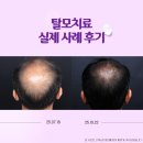 재즈in강서 어떤가요 | 강서구탈모병원, 아직 심하지 않은데 탈모치료를 시작해야 할까요?