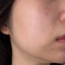 바노바기피부과의원 | 바노바기의원 창원 피부과에서 볼뉴머 리프팅 효과 및 통증