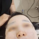 일산피부관리 리글로우에스테틱 MTS 관리후기