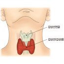 갑상선 기능 저하증 이미지