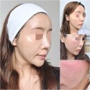 청담약국 | 청담피부과 5세대 스킨부스터 엘라비에 리투오 효과 부작용 솔직후기