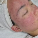 디또와 친구들 | 안양범계피부관리 좁쌀여드름 예비신부 솔직후기 | 디또뷰티안양범계점 (구)유리나스킨