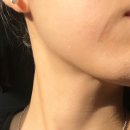 얼굴 흉터 치료 홍대 신촌 로담한의원 새살침 솔직후기 (4회차)