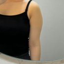 리안피부과의원 | 강남 미술관 피부과에서 지방분해주사 맞은 후기 팔뚝살 없애기 가능