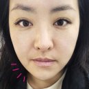 파주 성형외과 텐써마 300샷 후기와 효과 : 심부볼, 이중턱