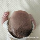 아주재활의학과의원 | 울산 아기 두상 교정 사두증/단두증 아이사랑두헬멧연계[아주재활의학과의원]