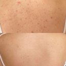 구수산도서관 주차장 | 대구 팔,등 모공각화증 관리, 몇 번 받아야 달라질까요? 칠곡3지구 등드름 관리 전후 비교 후기