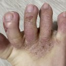 메타메디병원 | 데타손 연고 발가락 사이 습진 개선 사용법