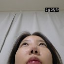 선천 | 선천적 돌출눈 수술후기, 안와확장술 비포애프터 3탄(2달차)