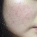 빛과 소금 | 여드름 영양제 여드름 피부관리 빛과 소금 같은 추천템