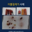 고은리프트의원 네이버블로그