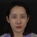소중한 개 | 팔자 턱선 실리프팅 + 볼필러 시술 전후, 1개월 후 변화는? (ft. 환자분의 소중한 후기)