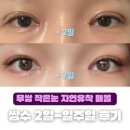 아이멍쥬 | 3] 인아웃라인 쌍수 이틀-일주일차 후기 자연유착 윗트임 붓기 멍 통증 부작용 무쌍 작은눈 쌍꺼풀수술...