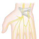 " 손목터널증후군 " (Carpal tunnel syndrome) 이미지