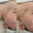 정담 | 청주 윤곽관리 정담에스테틱 달라진 후기