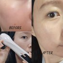듀얼소닉 맥시멈 후기 6주 사용 : 홍조 및 탄력개선 BEFORE &amp; AFTER